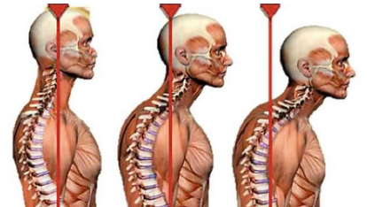[Александр Волоткевич] Практические примеры коррекции осанки и фигуры в сагиттальной плоскости (2025)